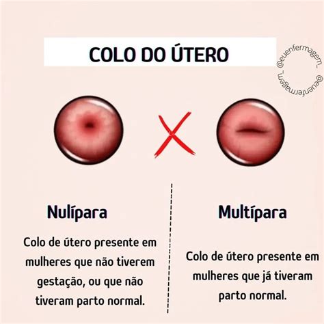 Colo do Útero Material de enfermagem Atividades de enfermagem Curso