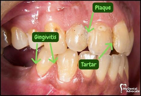 What Does Gingivitis Look Like 20 Gum Disease Pictures