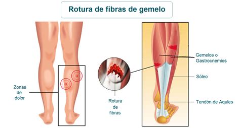 Rotura De Fibras De Gemelo Qu Es Causas S Ntomas Tratamiento Y