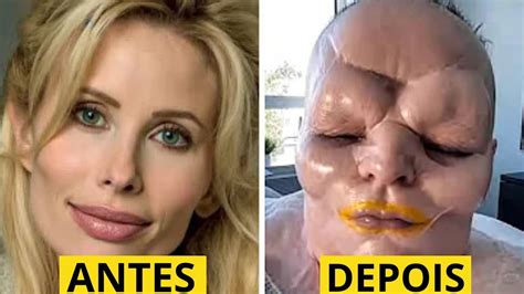 20 PESSOAS QUE FIZERAM PLÁSTICAS EXTREMAS E AGORA ESTÃO ARREPENDIDOS