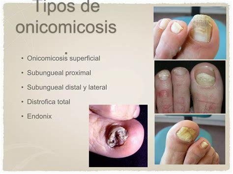 Micosis Superficiales Y Candidiasis Ppt