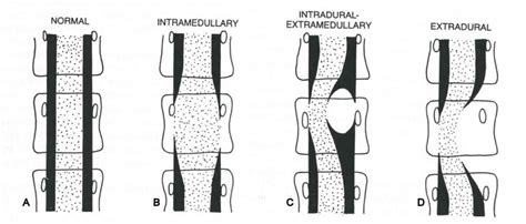 Mri Lumbar Spine Sagittal T Sagittal T Sag And Cor Mr Myelogram