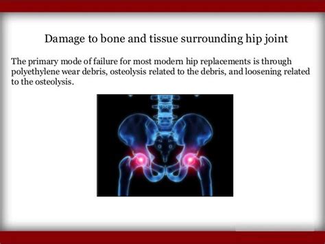 Symptoms of Hip Replacement Implant Recall