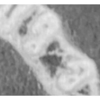 Different variations of root canal types in mandibular second premolar ...