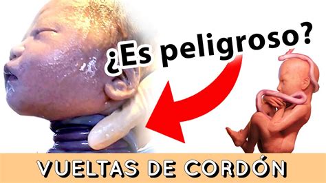 Mi bebé tiene vueltas de cordón Qué hago Es peligroso tener