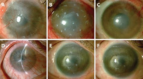 SciELO Brasil Assessment Of Surgical Outcomes Of Limbal