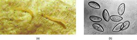 Parasite In Urine Under Microscope / 3 : Pus cells, wbc cast, bacteria ...