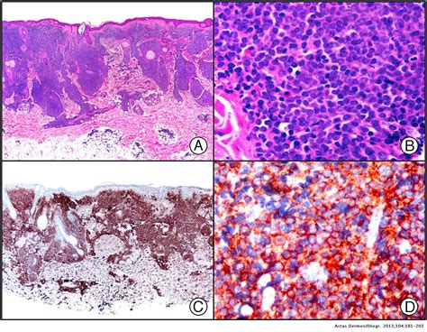 Immunohistochemistry In Dermatopathology A Review Of The Most Commonly