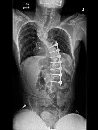 Scoliosis Surgery Overview Radiology Reference Article The Best Porn