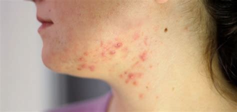 Acne On Neck Types Treatments And Prevention