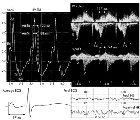 Example Of Atrioventricular AV Interval Measurements In A 21 Week