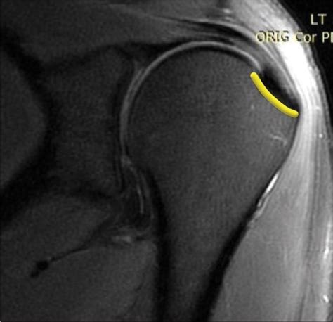 A plane-based approach for the characterization of supraspinatus tendon tear at the footprint in ...