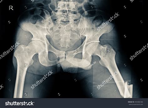 Xray Both Hip Show Closed Fracture Stock Photo Edit Now 493486186