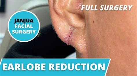 Earlobe Reduction Otoplasty Live Surgery Dr Tanveer Janjua New