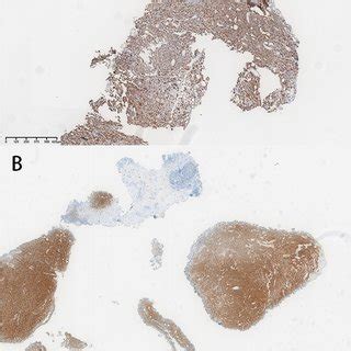 Pathological Evaluation Of The Third Operation Radical Cystectomy A