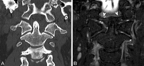 Diagnostic Benefit Of Mri For Exclusion Of Ligamentous Injury In Patients With Lateral