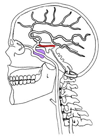 Missing Posterior Communicating Artery