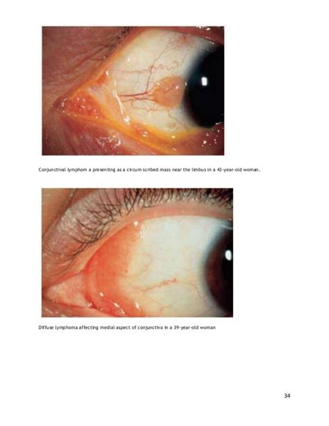 Conjunctival Tumors