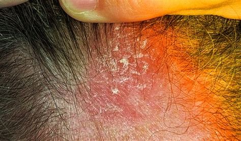 Psoriasis Cuero Cabelludo Las Causas Y S Ntomas De La Psoriasis En