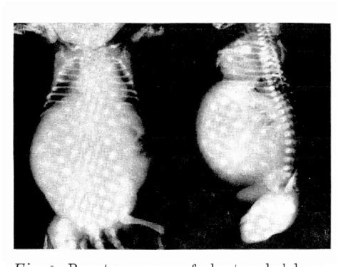 Figure 1 From A Neonatal Case With Congenital Hydronephrosis At Birth Semantic Scholar