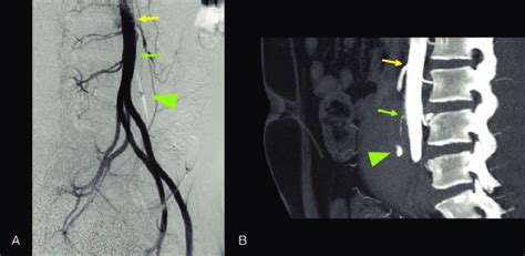 Right Oblique Image Of Aortography A And Left Lateral Image Of CT