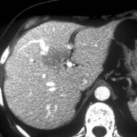 Steatotic Liver Disease Radiology Reference Article Radiopaedia Org