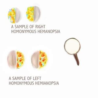 Dear Nurses: WHAT IS HEMIANOPIA