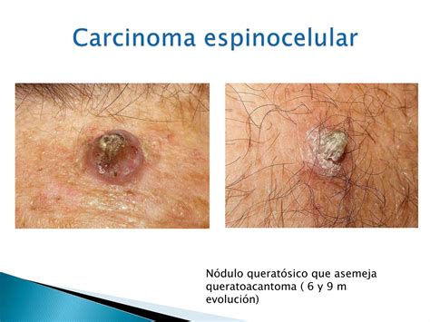 Carcinoma Basocelular Y Espinocelular Ppt