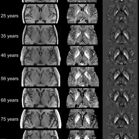 Examples Of T Weighted Mprage R And Qsm Susceptibility Maps From