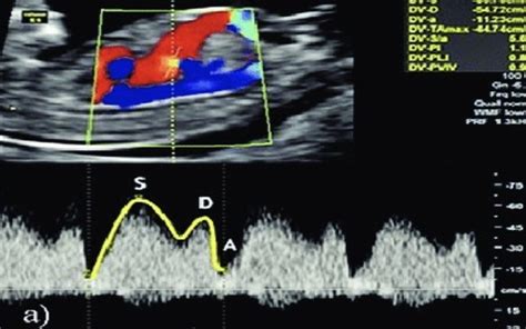 Fetal Biometry Growth And Doppler Flashcards Quizlet