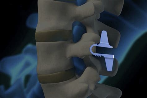 Coflex Spinal Implant Carl Spivak Md Executive Spine Surgery