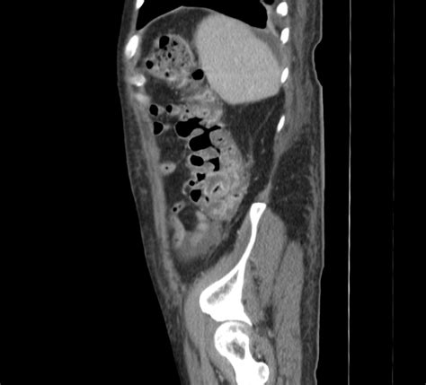 Pseudomembranous Colitis Image Radiopaedia Org