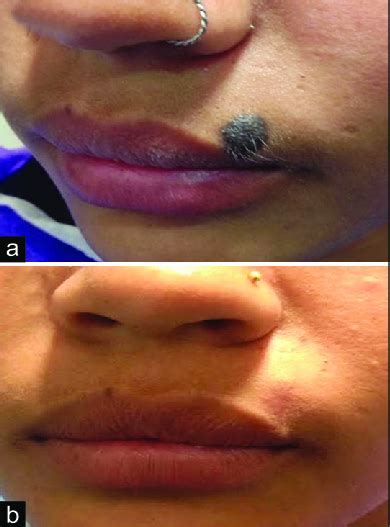 A A Compound Melanocytic Nevus Just Above The Upper Lip At Baseline