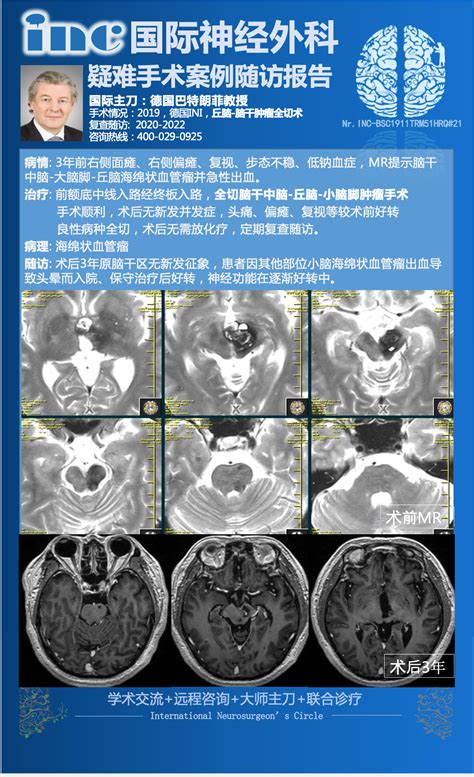 Inc国际教授手术快报五：脑干中脑 大脑脚 丘脑海绵状血管瘤急性出血，获安全全切 Medscicn