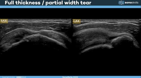 Knowledge On Rotator Cuff Tears You Should Know Before Starting A Musculoskeletal Ultrasound Exam