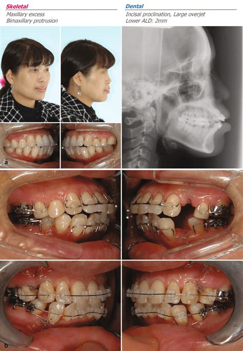 Strategy For Class Ii Orthognathic Surgery Orthodontic Perspective Pocket Dentistry