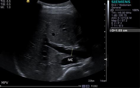 Abdominal Doppler Hepatic Vasculature Flashcards Quizlet