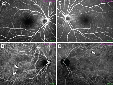 Fundus Photographs Of Fluorescein Angiography A And C And Indocyanine Download Scientific