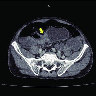 Axial Views Of The Ct Abdomen Showing A Mass Within The Rectosigmoid