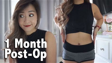 Tummy Tuck 1 Month Post Op Update YouTube