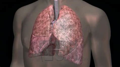 Qu Es La Fibrosis Pulmonar Y Cu Les Son Sus Principales S Ntomas