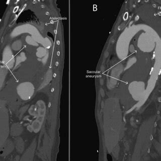 Postoperative 3D Reconstruction Of The Aorta With The Interposition