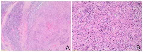 Challenges In The Differential Diagnosis Of Interdigitating Dendritic