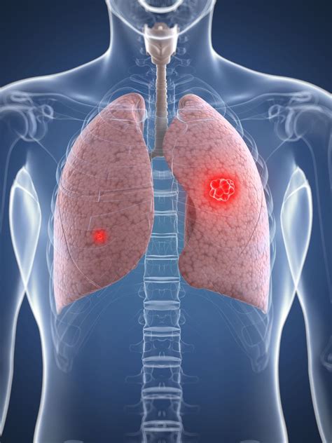 Pleural Effusion and Disorders of the Pleural Cavity