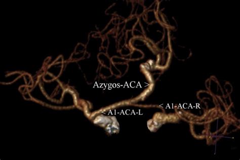 Azygos Anterior Cerebral Artery Posterior Vr Projection Of Ct