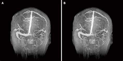 Cavernous Sinus Thrombosis Mrv