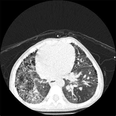 Right Proximal Interruption Of The Pulmonary Artery With Hemoptysis