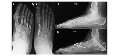 Preoperative A And C And Postoperative B And D Weightbearing