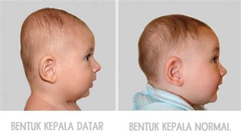 Perhatikan Kepala Bayi Anda Jika Bentuknya Datar Ini Risikonya Pada