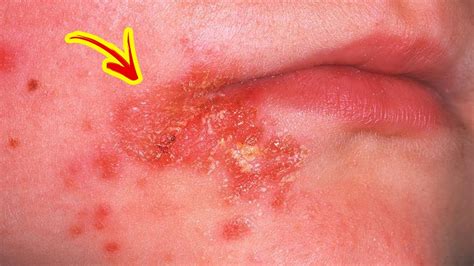 How To Treat Impetigo At Home 6 Simple Home Remedies For Impetigo